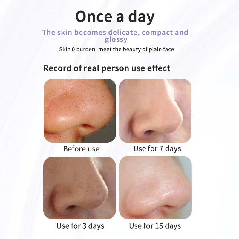 Blackhead Remover Vacuum Suction Water Cycle Pore Acne Cleaner USB Rechargeable Black Head Removal  Face Cleaner
